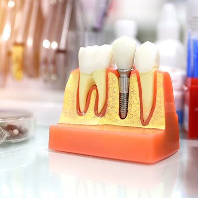 Patient learning cost of dental implants in Frisco with dentist