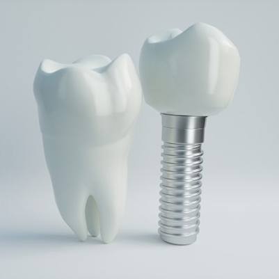 dental implant and crown next to a natural tooth