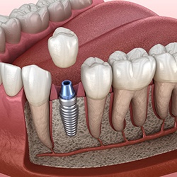 dental crown being placed on an implant post