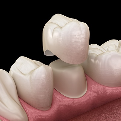 All ceramic dental restoration placement