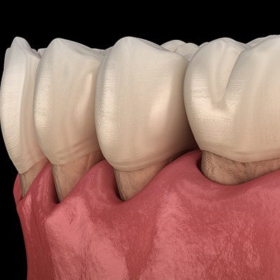 receding gums from gum disease
