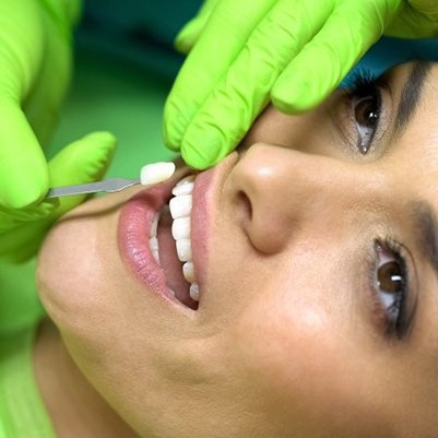 cosmetic dentist in Carrollton, TX placing veneers on woman