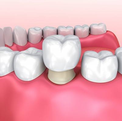diagram of dental crown going onto tooth